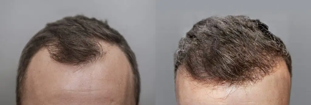 efekt przeszczepu wlosow w klinice