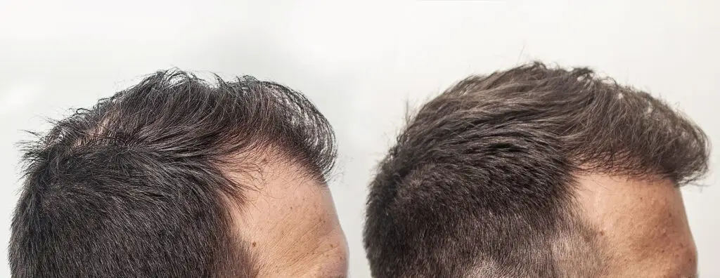 wlosy po przeszczepie bok klinika mironski