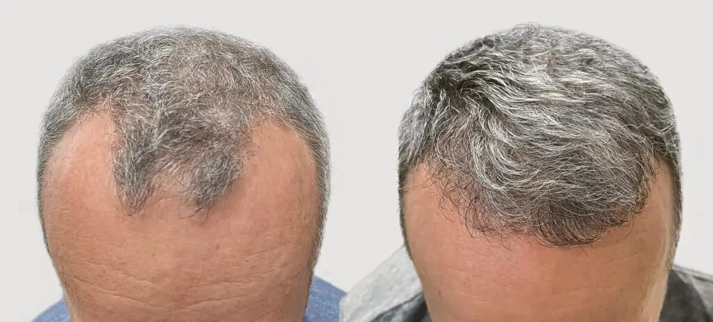 wlosy po przeszczepie klinika ignacy mironski