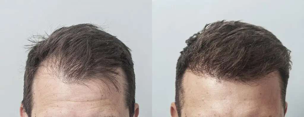 wlosy po przeszczepie klinika mironski