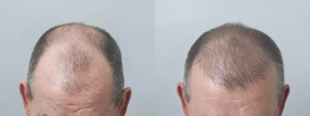 wlosy po przeszczepie klinika mironski przeszczep