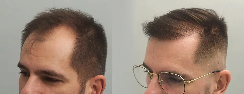 przeszczep wlosow klinika ignacy mironski 1