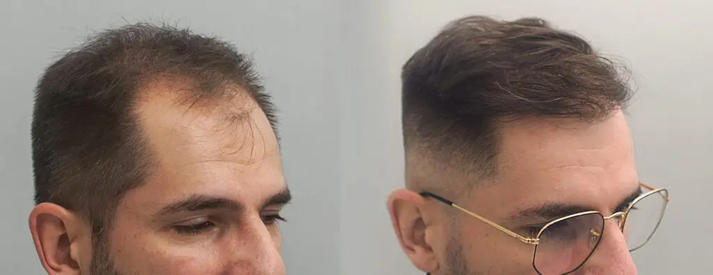 przeszczep wlosow klinika ignacy mironski 2