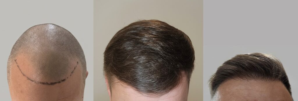 przeszczep wlosow efekt