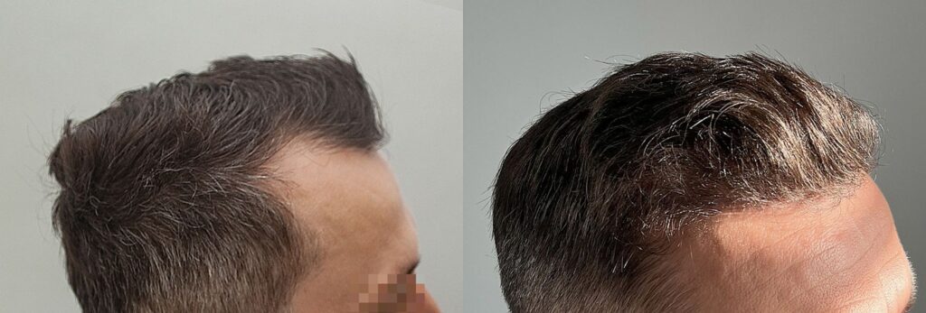 przeszczep wlosow efekt 2