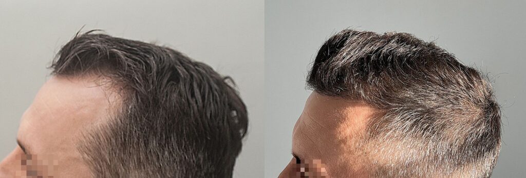 przeszczep wlosow efekt 3