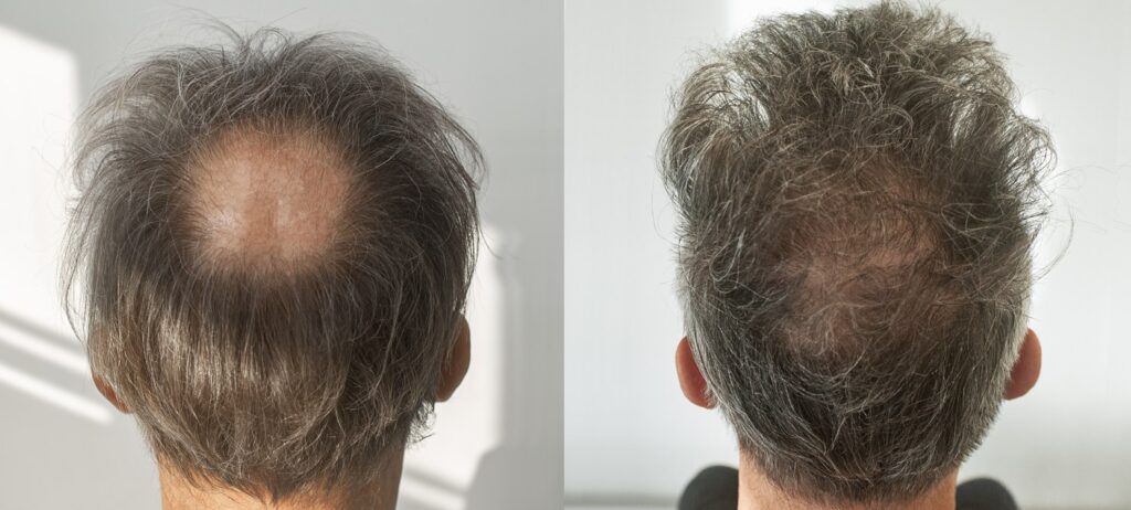 przeszczep wlosow efekt 4